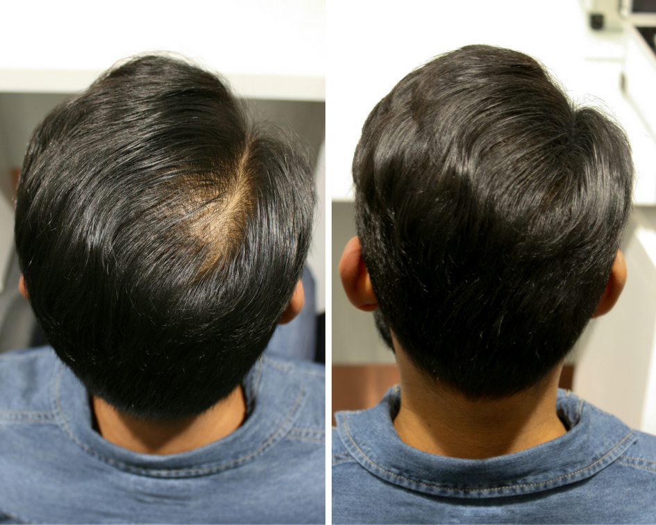 Top Fiber Hiustuuhenne Ennen ja jälkeen kuvat