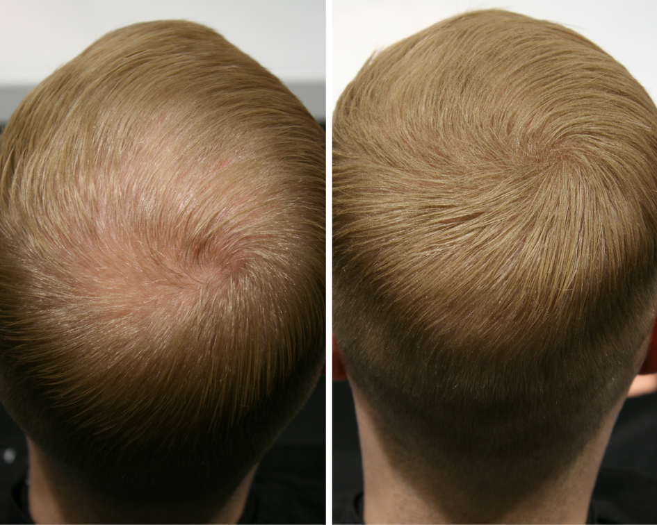 Top Fiber Hiustuuhenne Ennen ja Jälkeen kuvat